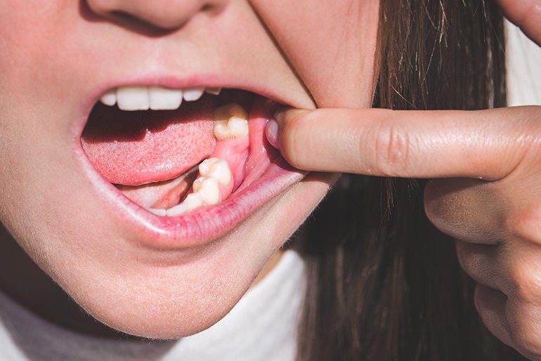 How Dentists Evaluate Changes In Tooth Position After Losing A Back Tooth